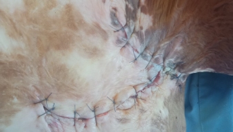 Phẫu thuật xoay vạt da tại chỗ cho một bệnh nhân bị nhiễm trùng sẹo lồi do bỏng 