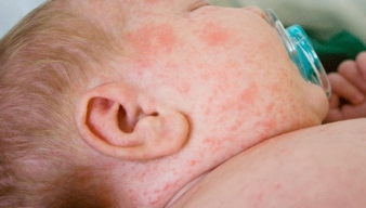 Viêm da cơ địa ở trẻ sơ sinh: Nhận biết sớm và chăm sóc đúng cách để bảo vệ làn da non nớt