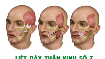 Liệt dây thần kinh số 7: Dấu hiệu nhận biết sớm và những điều người bệnh cần lưu ý