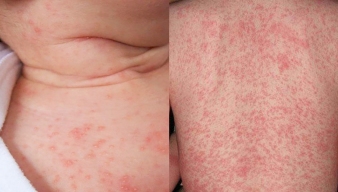 Rôm sảy ở trẻ em: Nguyên nhân, dấu hiệu nhận biết và cách phòng tránh hiệu quả