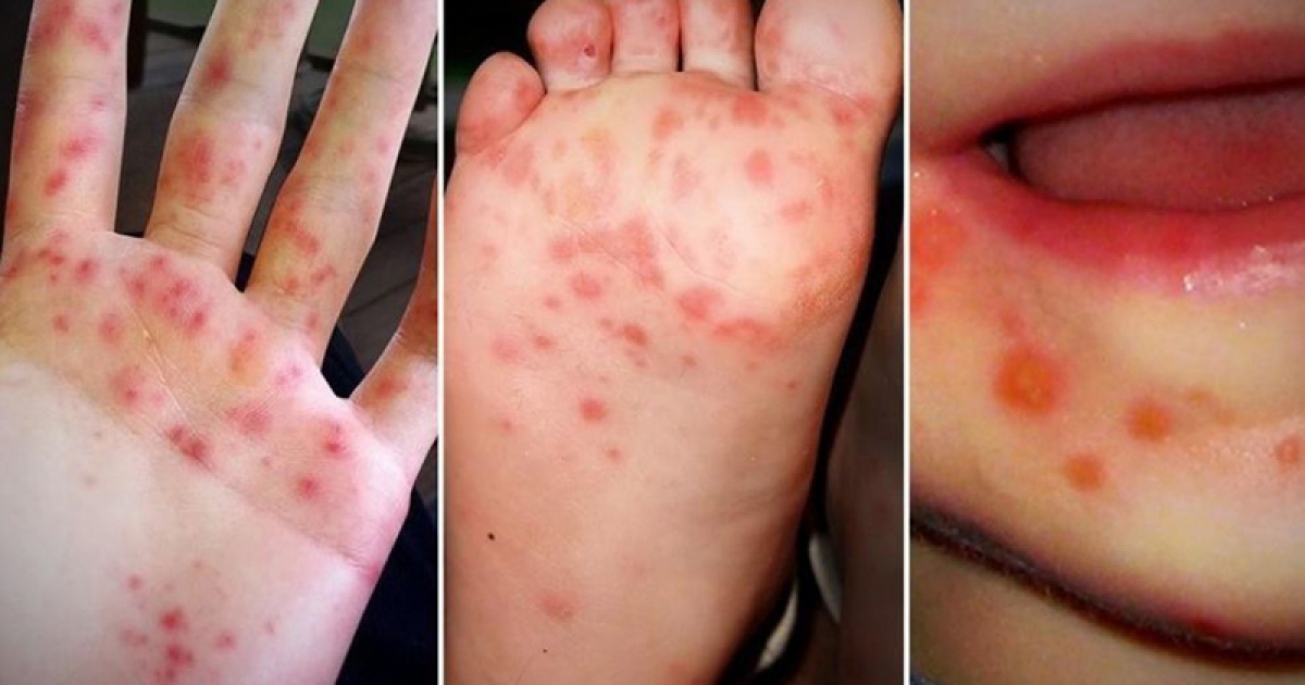 Tăng cường phòng, chống bệnh tay chân miệng ở trẻ em