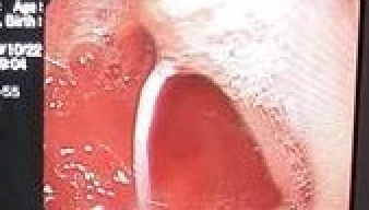  Nội soi gắp dị vật rơi vào đường tiêu hóa - phương pháp hữu hiệu nhằm tránh những hiểm họa khó lường