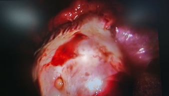 Một cuộc mổ nội soi giải quyết 3 tổn thương: cắt ruột thừa, cầm máu chảy từ buồng trứng phải, cắt bỏ khối u buồng trứng