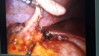 Phẫu thuật cắt ruột thừa dưới gan: Một trường hợp hiếm gặp