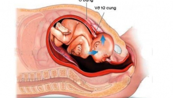 Võ tử cung trong chuyển dạ: Nguyên nhân và những dấu hiệu nhận biết