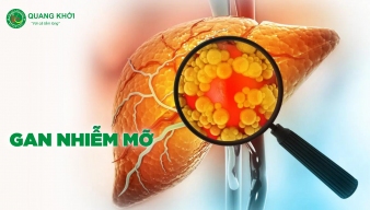 Hiểu đúng về gan nhiễm mỡ